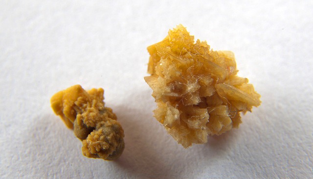 kidney-stones-education-treatment-diet-wovow.org-03