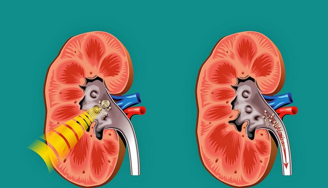 kidney-stones-education-treatment-diet-wovow.org-04
